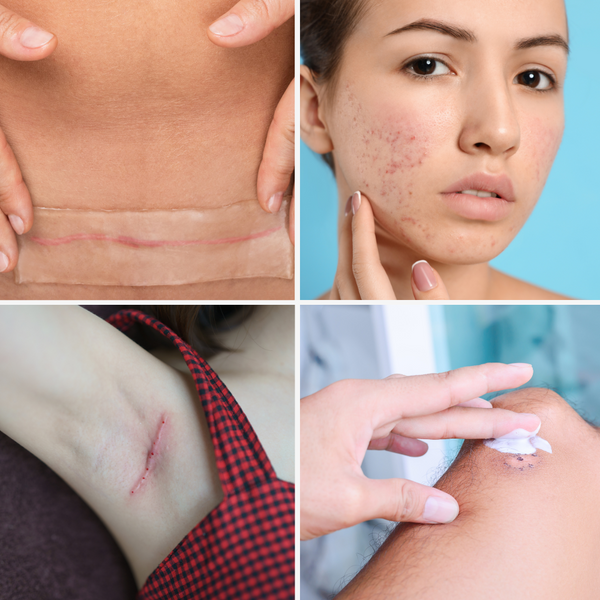 Silicone Scar Tape: A Simple Solution for Smoother Skin Healing